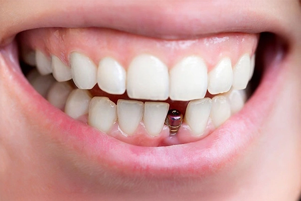 İmplant Tedavisinde En Çok Sorulan Sorular Ön diş bölgesine yerleştirilmiş bir dental implant vidasını gösteren klinik fotoğraf
