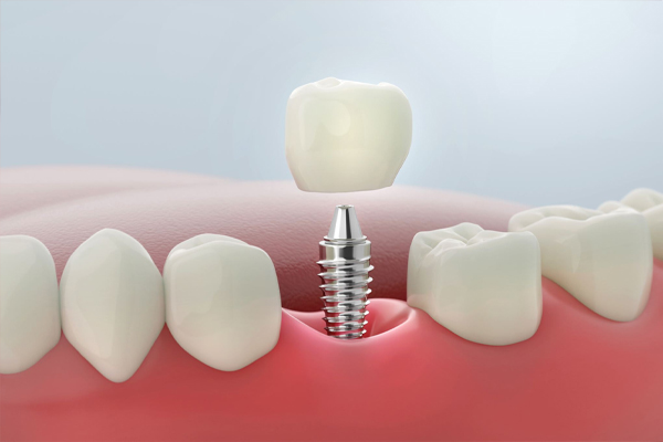 Diş implantı uygulamasını gösteren 3D görsel