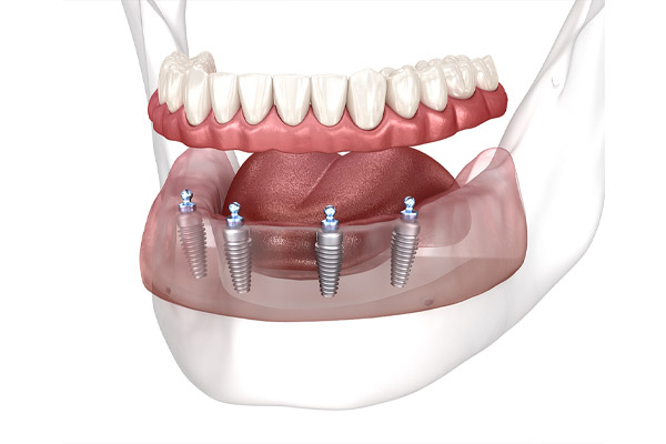 Alt Çeneye Uygulanan All On Four İmplant Tedavisi 3D Modeli