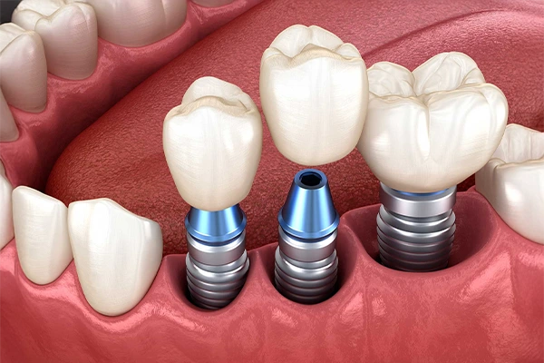 Vidasız implant üzerine yerleştirilen porselen dişlerin 3D görselleştirilmiş görünümü