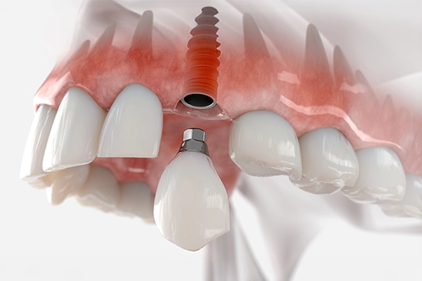 Vidasız implant ve üzerine yerleştirilen porselen kronun 3D görselleştirilmiş görünümü
