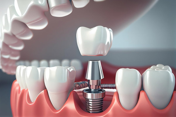 İmplant Tedavisinde En Çok Sorulan Sorular Alt çeneye yerleştirilen diş implantı üzerine abutment ve porselen kron yerleştirilme aşaması