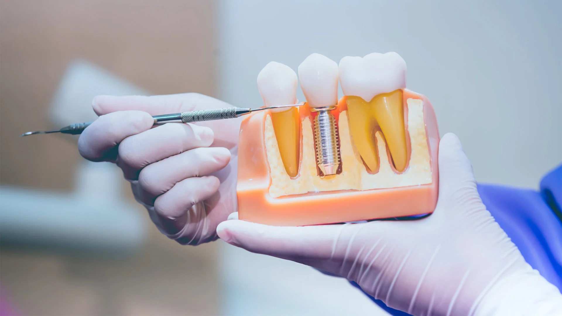 implant-fiyatları-2025