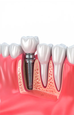 implant tedavisi