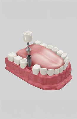 implant-üstü-protez