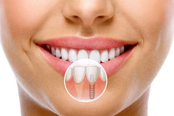 izmir-implant-tedavisi