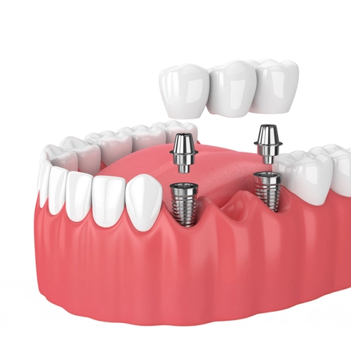 Diş implantı uygulaması 3D görseli