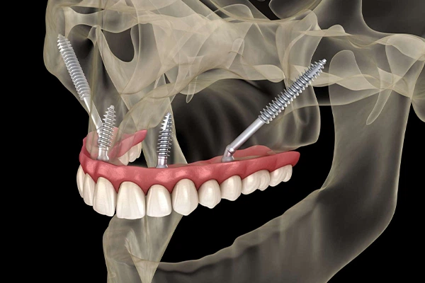 Üst çeneye yerleştirilmiş zigomatik ve geleneksel implantları gösteren 3D görsel