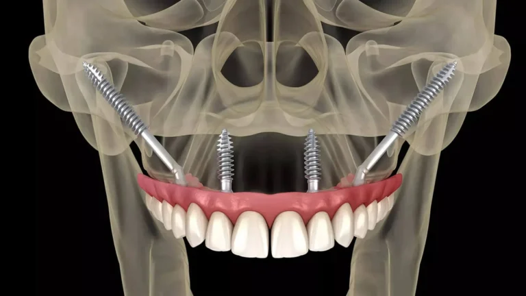 Zigomatik İmplant Nedir? Nasıl Yapılır? zigomatik-implant