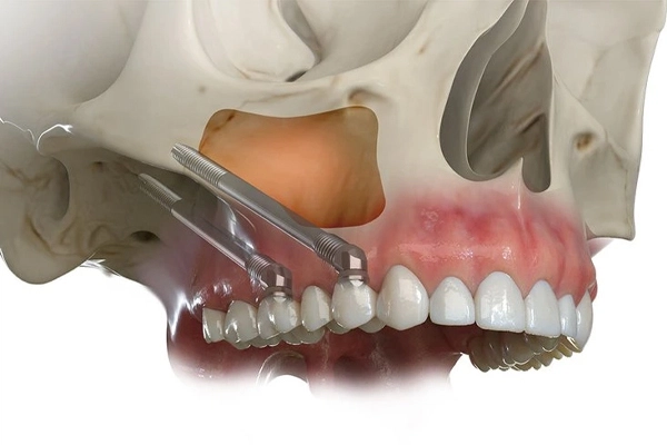 Zigoma implantlarının elmacık kemiğine yerleştirildiğini gösteren anatomik 3D görsel