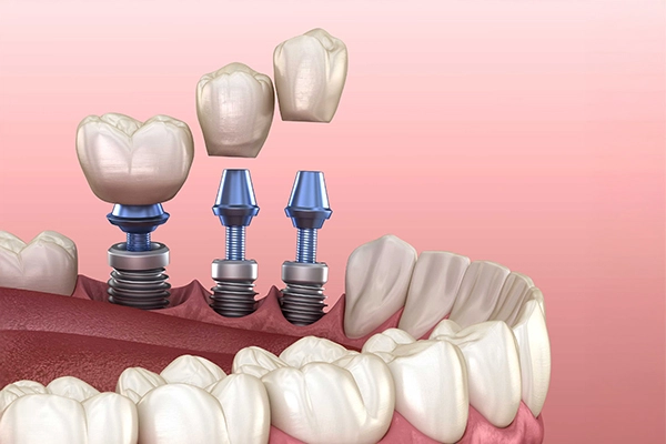 Birden fazla diş implantı uygulamasını gösteren 3D görsel