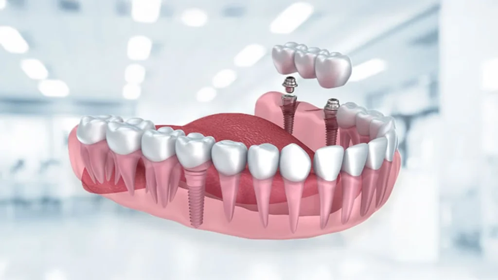 Alt çeneye uygulanan çoklu diş implantlarını ve köprü protez yerleştirme aşamasını gösteren 3D görsel