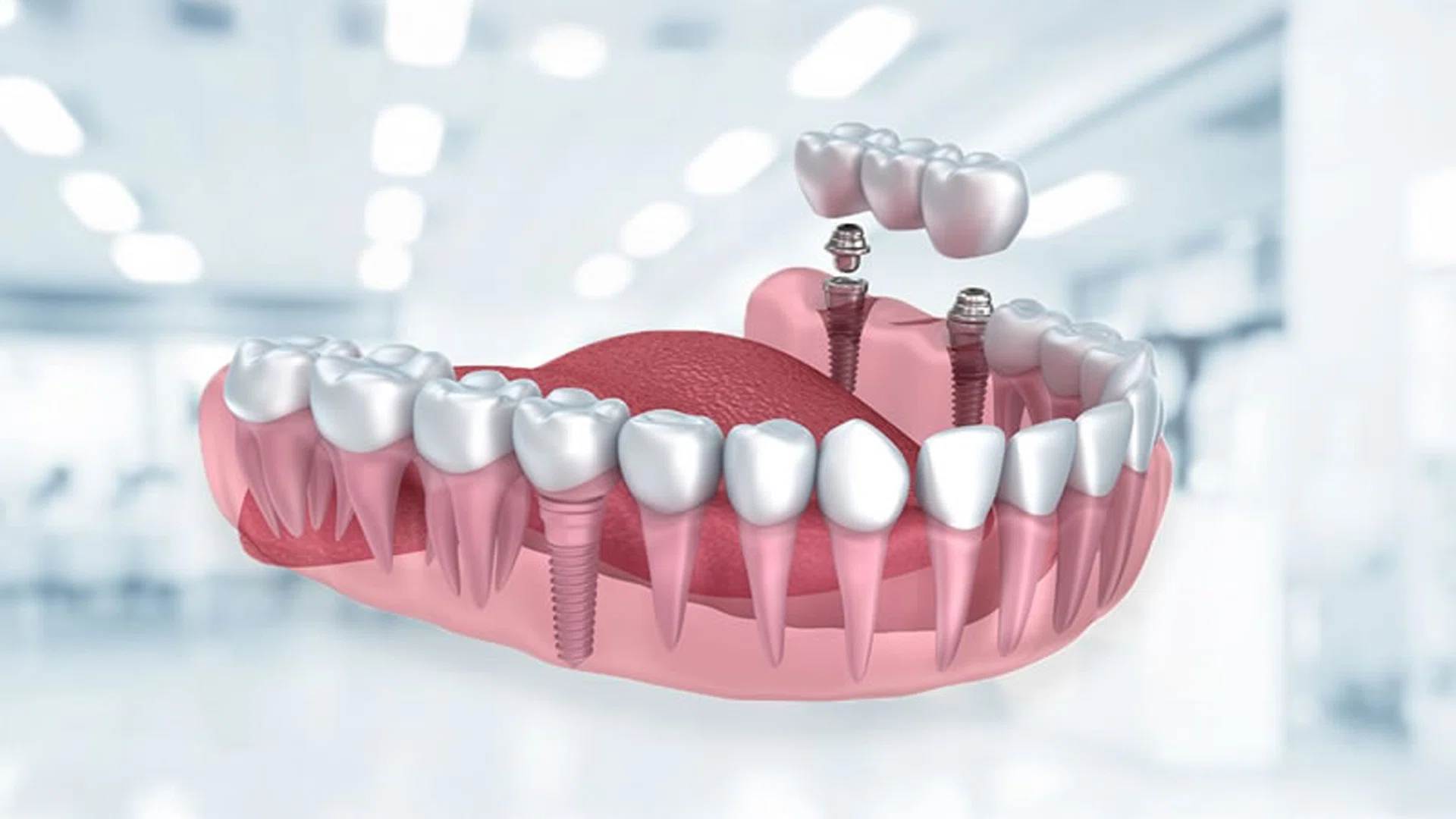 Alt çeneye uygulanan çoklu diş implantlarını ve köprü protez yerleştirme aşamasını gösteren 3D görsel