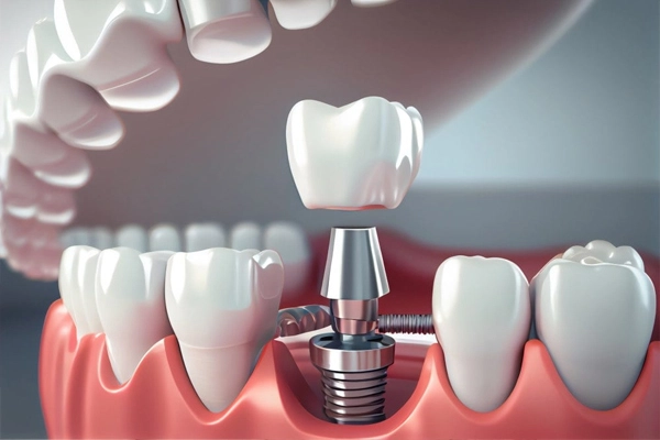 Diş implantı uygulamasının aşamalarını gösteren 3D görsel