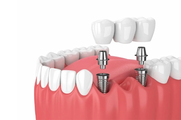Yerli İmplant mı Yoksa Yabancı İmplant mı Tercih Edilmeli? Üç diş eksikliğinin tedavisi için kullanılan iki adet dental implantın üzerine yerleştirilen sabit köprü protezini gösteren 3D diş implantı görseli