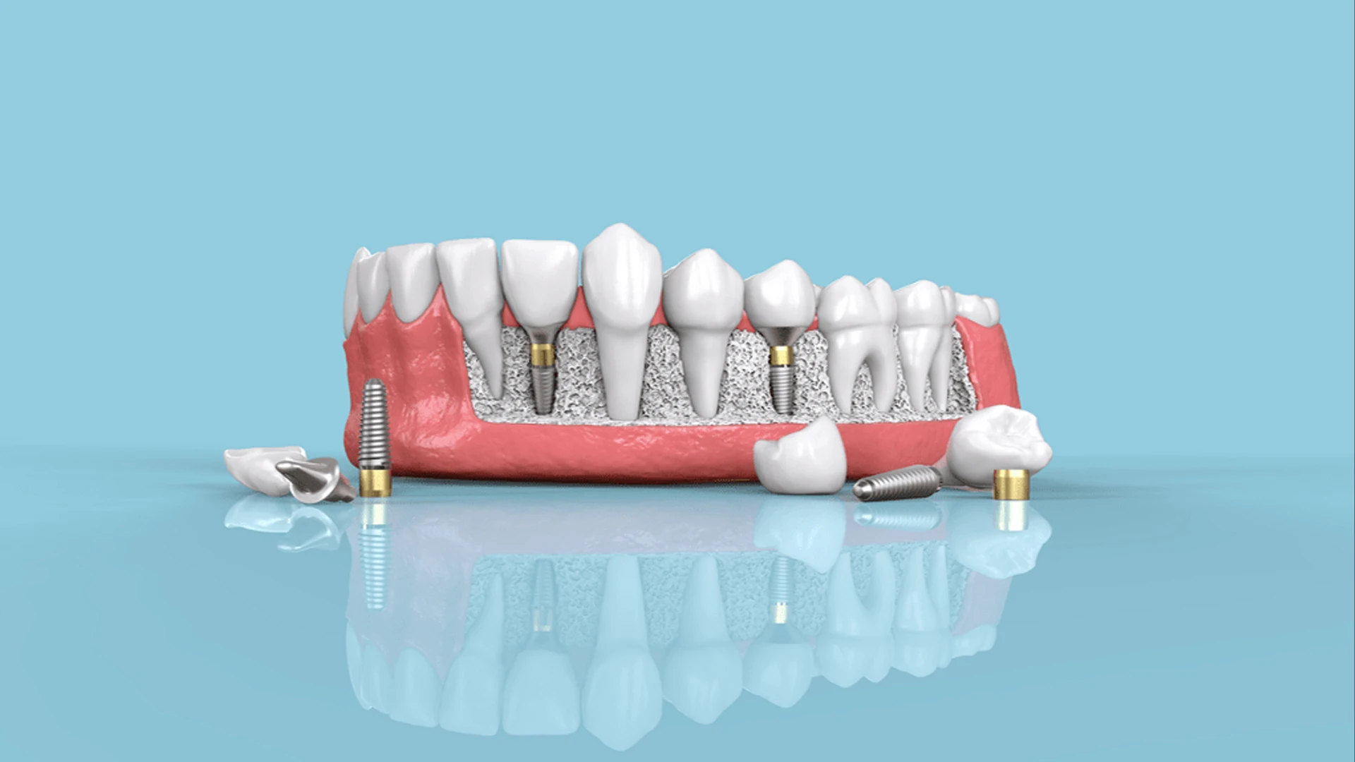 Çene kemiği içerisine yerleştirilmiş çok sayıda dental implant, üst yapı bağlantı parçaları ve porselen kronlar