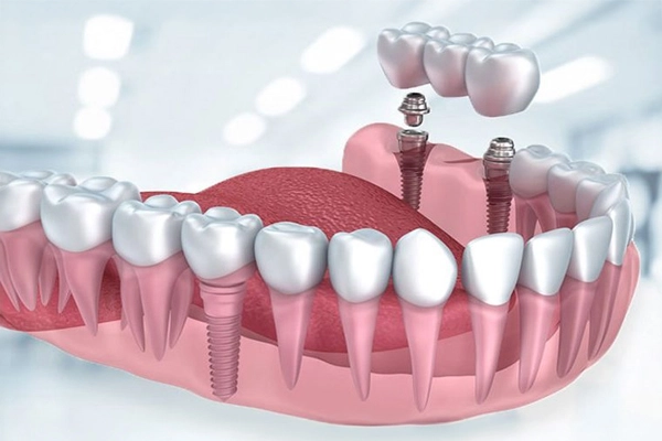 Yerli İmplant mı Yoksa Yabancı İmplant mı Tercih Edilmeli? Alt çenede birden fazla diş eksikliğinin tedavisi için yerleştirilen dental implantlar üzerine sabit köprü protez uygulanışını gösteren 3D implant tedavisi görseli