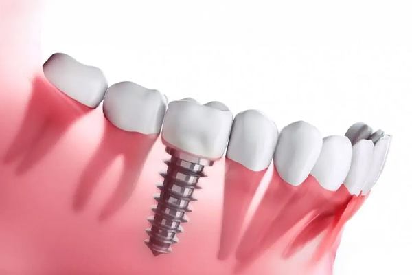 İmplant Fiyatları Neye Göre Değişir? Açılı yerleştirilmiş bir diş implantı ve üzerine yerleştirilen protez diş