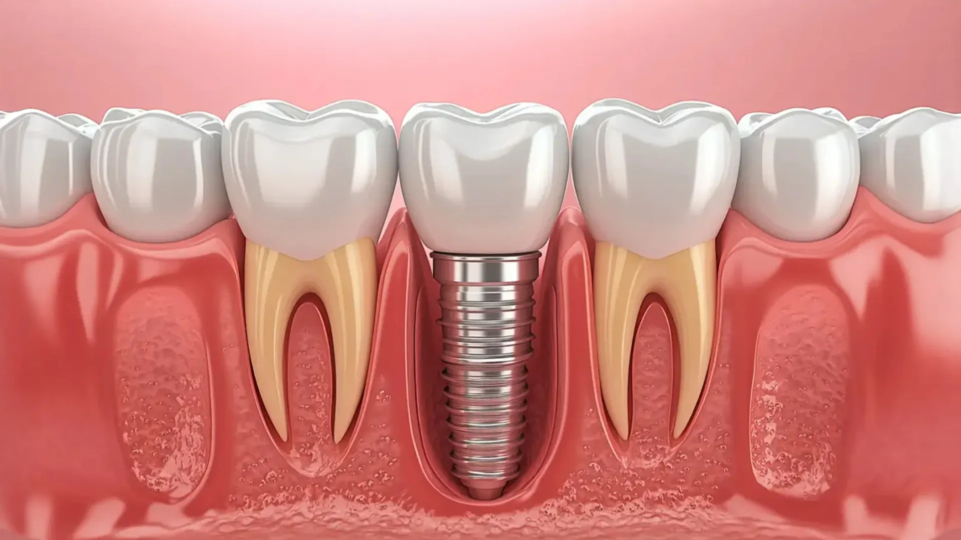 Çene kemiğine yerleştirilmiş bir diş implantını gösteren görsel
