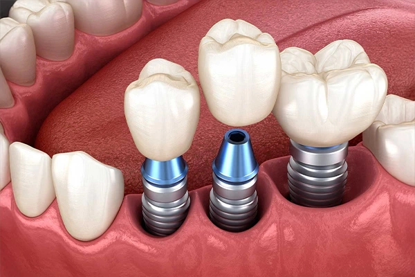 Alt çeneye yerleştirilmiş üç adet diş implantının, porselen dişlerle birlikte gösterildiği 3D görsel