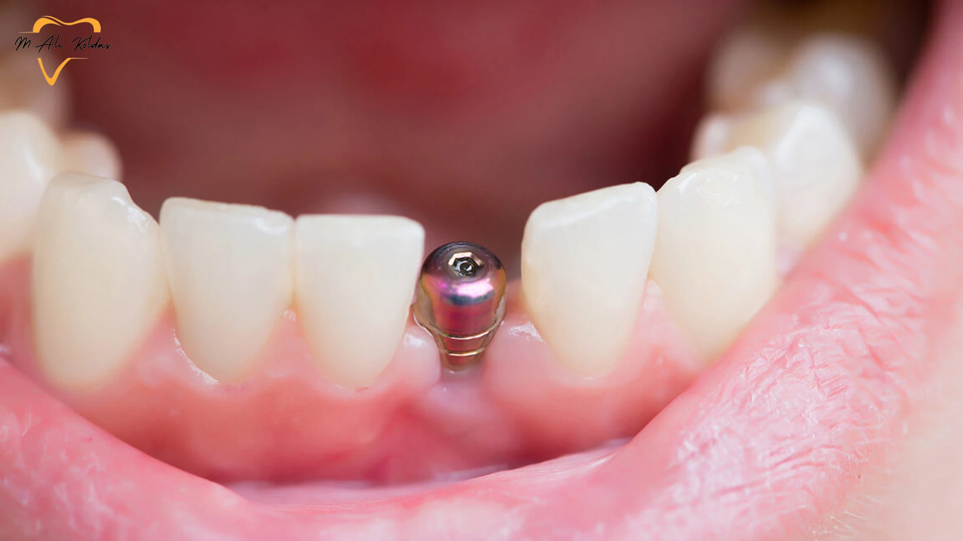 Dikişsiz implant sonrası, diş etinde küçük delikten çıkan iyileşme başlığı yakın plan.