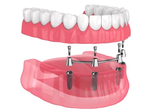 32-dis-implant-fiyatlari