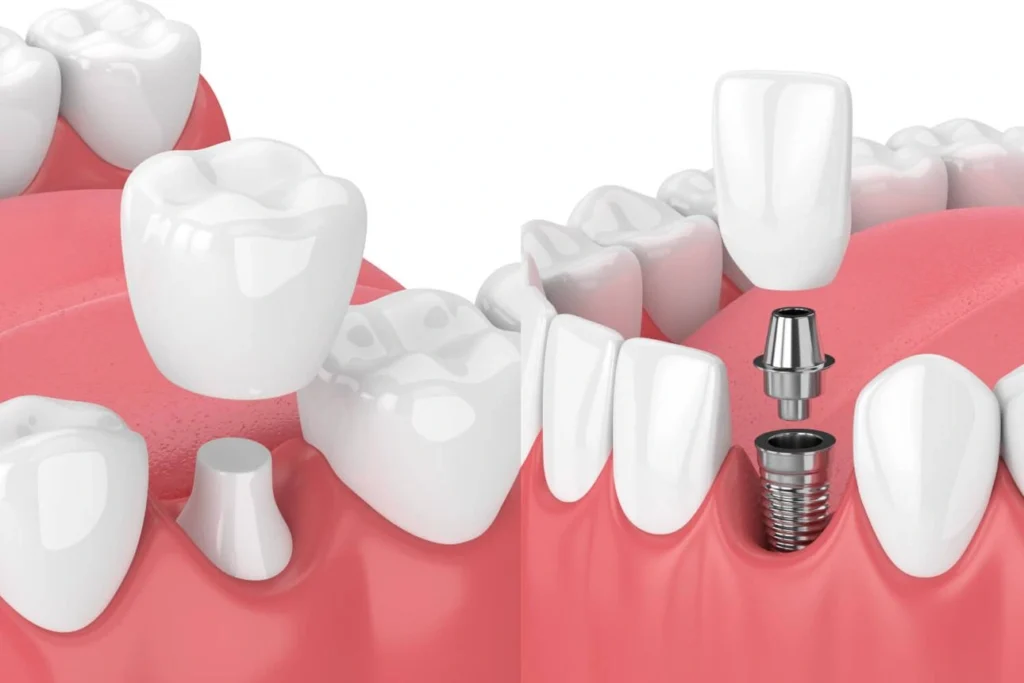 implant ve kaplama arasındaki farklar
